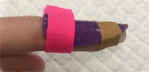 splinting.JPG