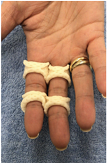 Buddy splint.png