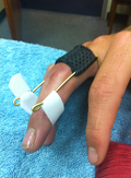 Mobilising splint.png