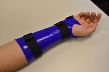 hand with splint_2.jpg