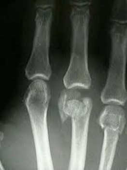 Metacarpal head fracture.jpg
