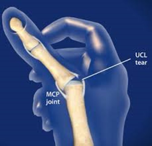 UCL injury.jpg