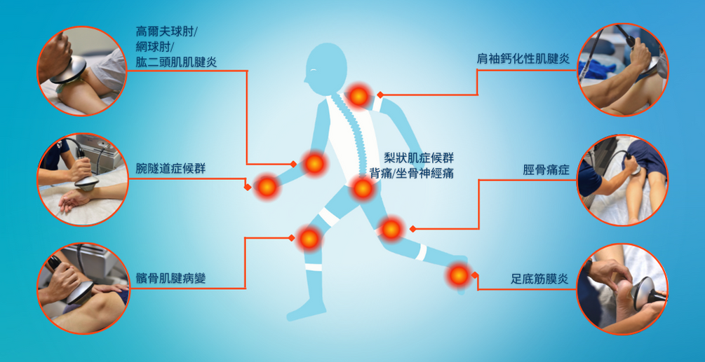 聚焦性衝擊波服務.png